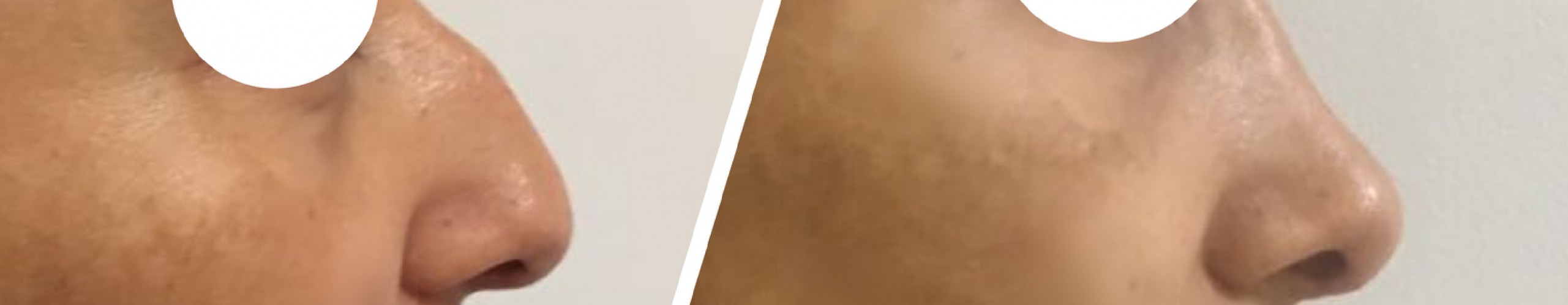 Rinoplastia realizada por nuestro equipo.