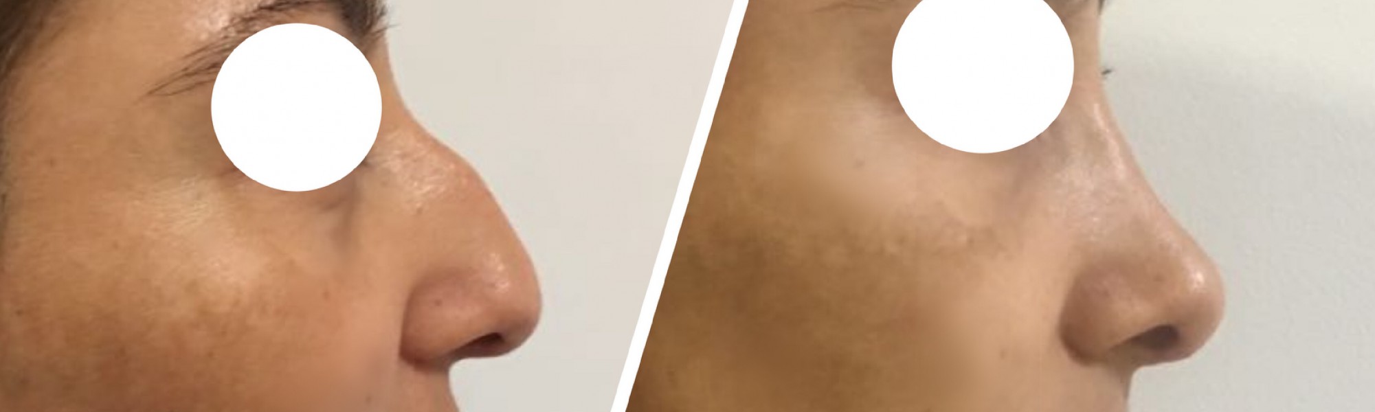 Rinoplastia realizada por nuestro equipo.